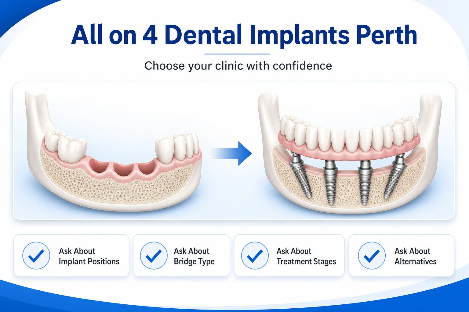 all on 4 dental implants perth: how to choose a clinic (2026 guide)